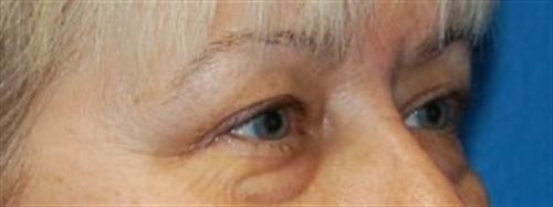 Eyelid Surgery Before and After | SGK Plastic Surgery