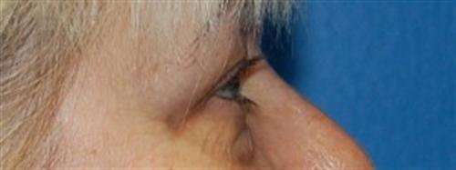 Eyelid Surgery Before and After | SGK Plastic Surgery