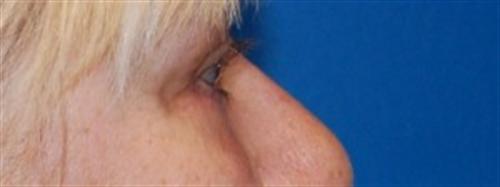 Eyelid Surgery Before and After | SGK Plastic Surgery