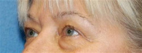 Eyelid Surgery Before and After | SGK Plastic Surgery