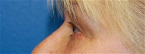 Eyelid Surgery Before and After | SGK Plastic Surgery