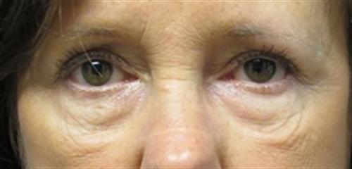 Eyelid Surgery Before and After | SGK Plastic Surgery