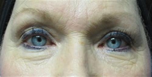 Eyelid Surgery Before and After | SGK Plastic Surgery