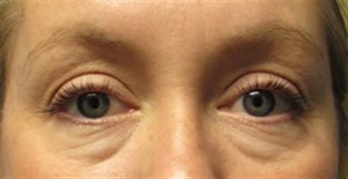 Eyelid Surgery Before and After | SGK Plastic Surgery