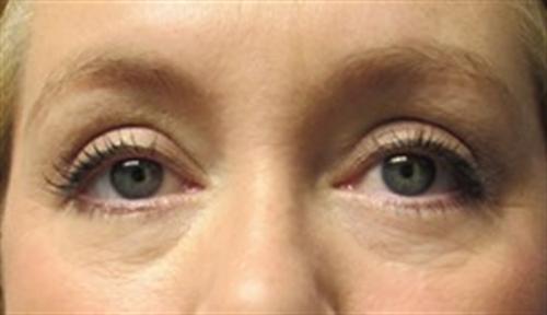 Eyelid Surgery Before and After | SGK Plastic Surgery