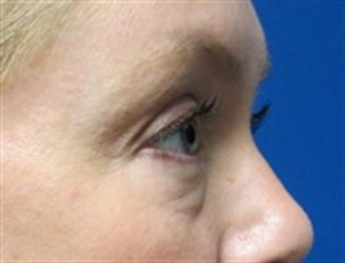 Eyelid Surgery Before and After | SGK Plastic Surgery