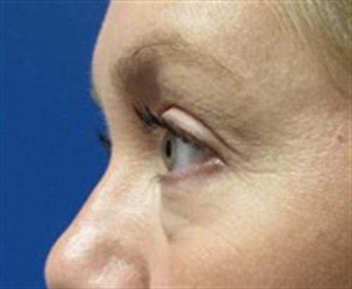 Eyelid Surgery Before and After | SGK Plastic Surgery