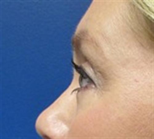 Eyelid Surgery Before and After | SGK Plastic Surgery