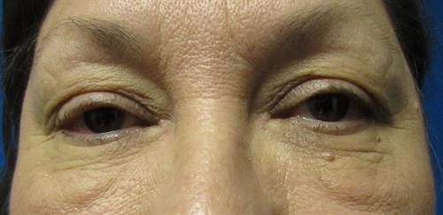 Eyelid Surgery Before and After | SGK Plastic Surgery