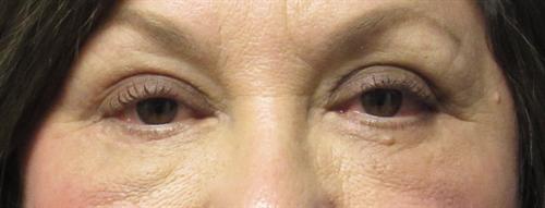 Eyelid Surgery Before and After | SGK Plastic Surgery