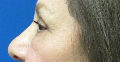 Eyelid Surgery Before and After | SGK Plastic Surgery