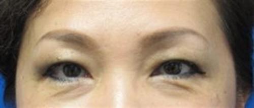 Eyelid Surgery Before and After | SGK Plastic Surgery