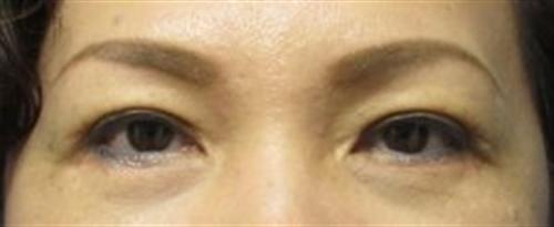 Eyelid Surgery Before and After | SGK Plastic Surgery