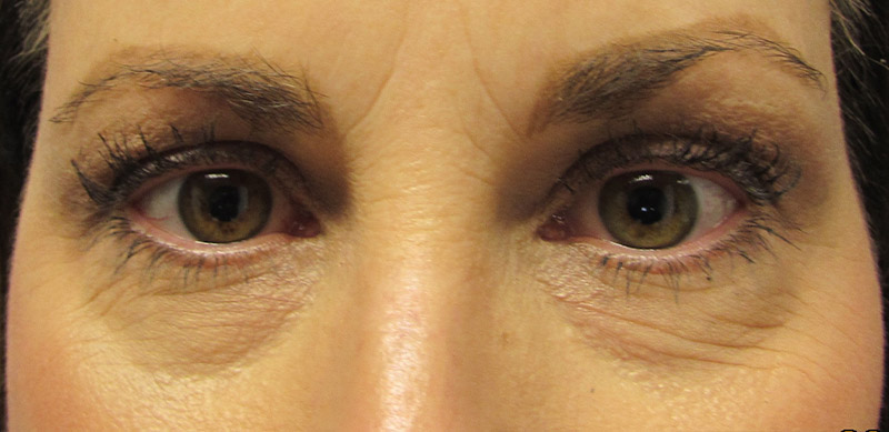 Eyelid Surgery Before and After | SGK Plastic Surgery