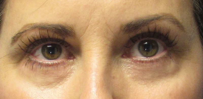 Eyelid Surgery Before and After | SGK Plastic Surgery