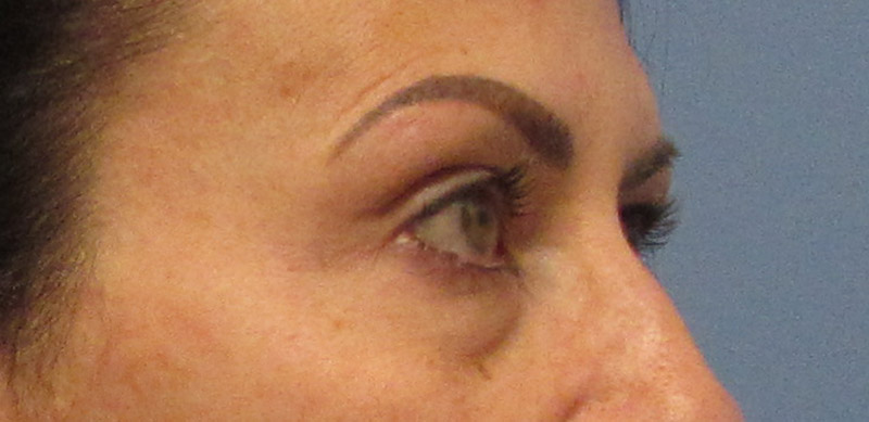 Eyelid Surgery Before and After | SGK Plastic Surgery