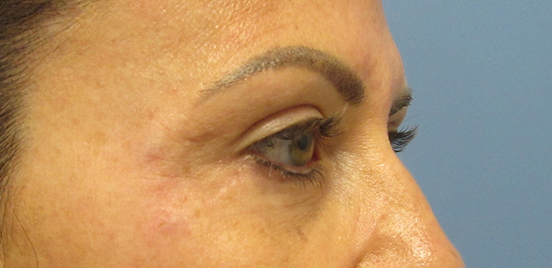 Eyelid Surgery Before and After | SGK Plastic Surgery