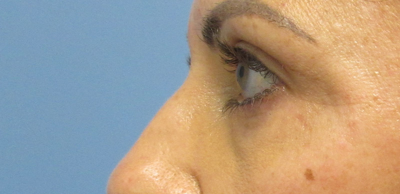 Eyelid Surgery Before and After | SGK Plastic Surgery