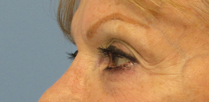 Eyelid Surgery Before and After | SGK Plastic Surgery