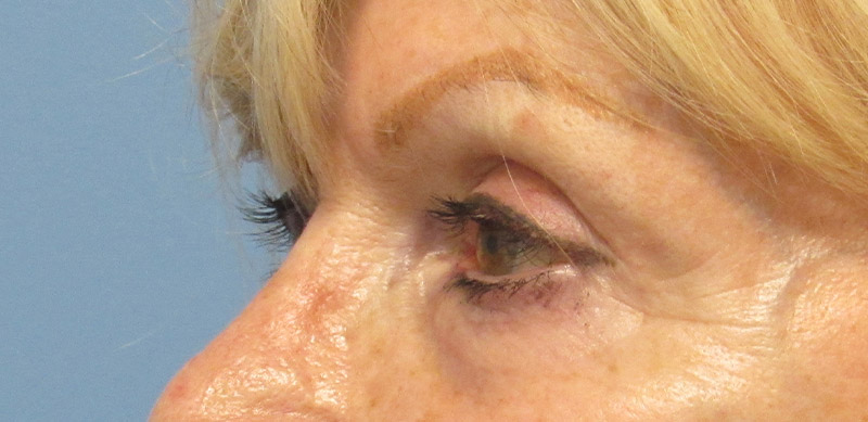 Eyelid Surgery Before and After | SGK Plastic Surgery