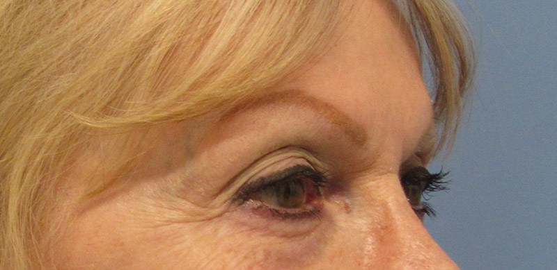 Eyelid Surgery Before and After | SGK Plastic Surgery