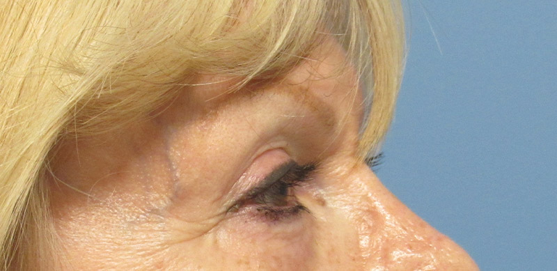 Eyelid Surgery Before and After | SGK Plastic Surgery