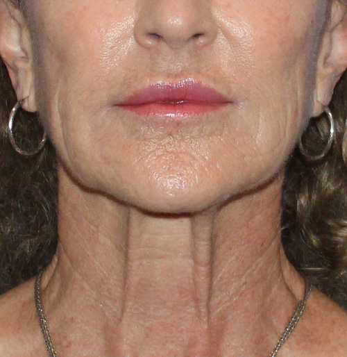 Facelift Surgery in The Woodlands, TX