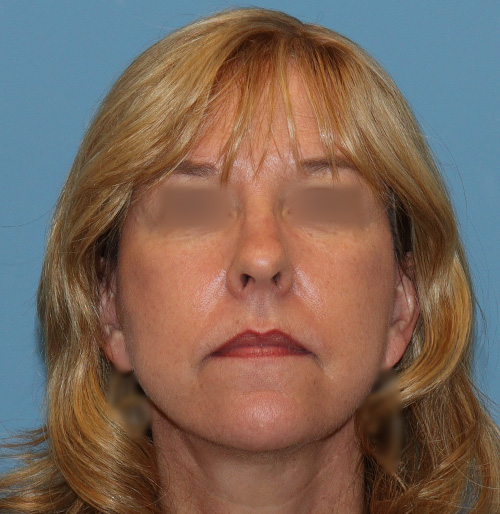 Facelift Surgery in The Woodlands, TX