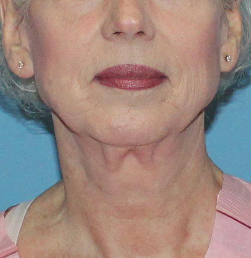 Facelift Surgery in The Woodlands, TX