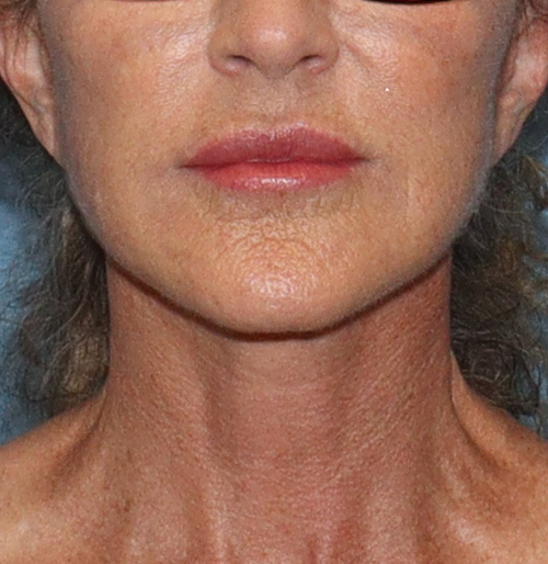 Facelift Before and After | SGK Plastic Surgery