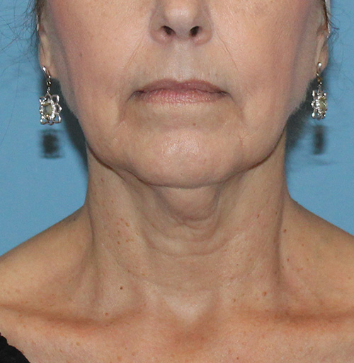 Facelift Before and After | SGK Plastic Surgery