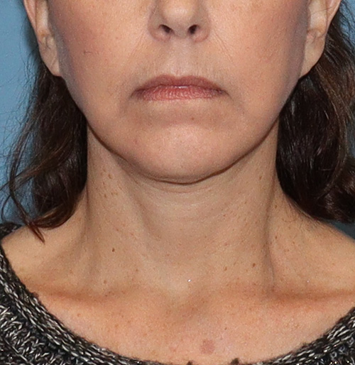 Facelift Before and After | SGK Plastic Surgery