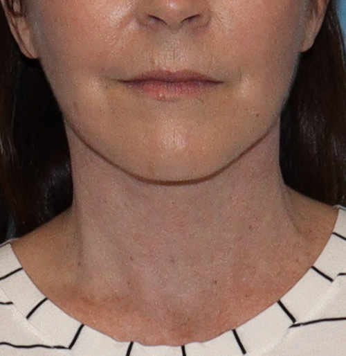 Facelift Before and After | SGK Plastic Surgery