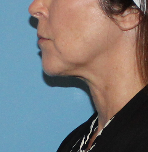 Facelift Before and After | SGK Plastic Surgery