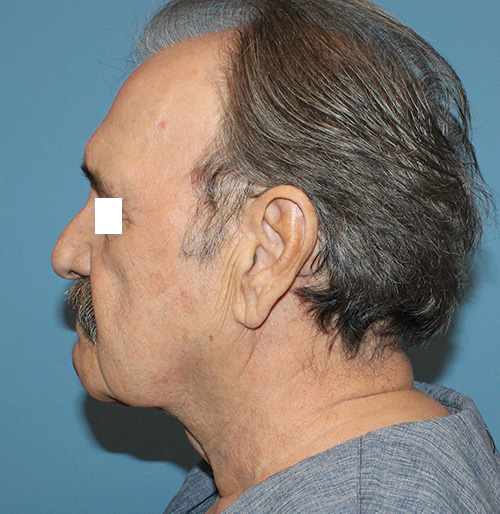 Facelift Before and After | SGK Plastic Surgery