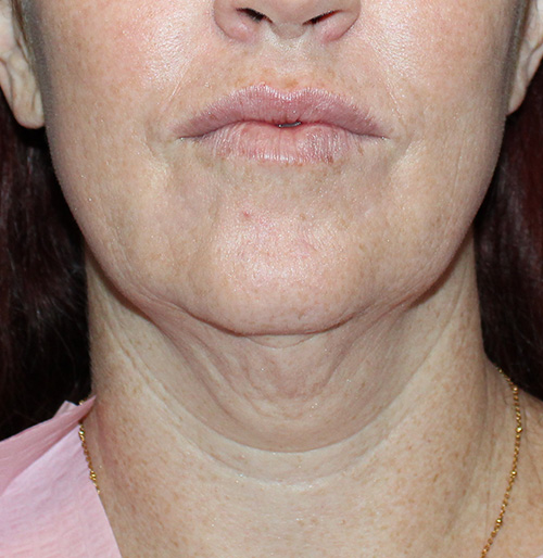 Facelift Before and After | SGK Plastic Surgery