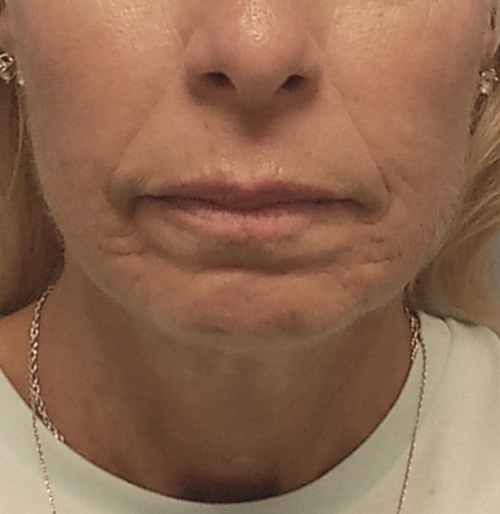 Facelift Before and After | SGK Plastic Surgery