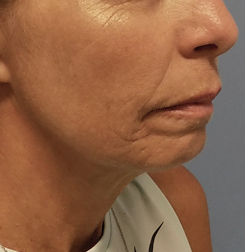 Facelift Before and After | SGK Plastic Surgery