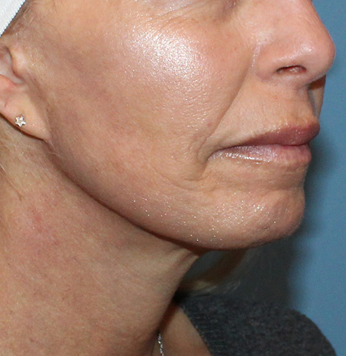 Facelift Before and After | SGK Plastic Surgery