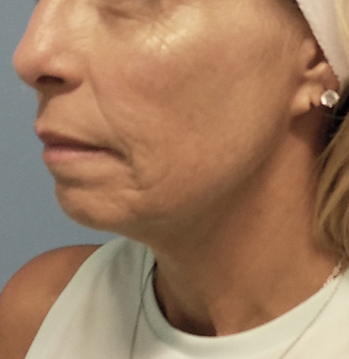 Facelift Before and After | SGK Plastic Surgery