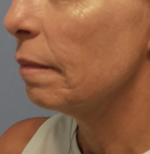 Facelift Before and After | SGK Plastic Surgery