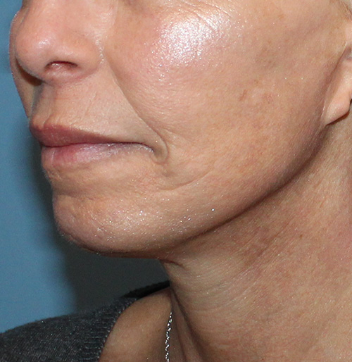 Facelift Before and After | SGK Plastic Surgery