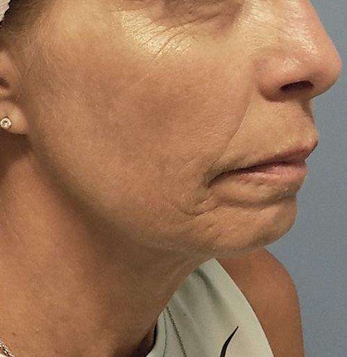 Facelift Before and After | SGK Plastic Surgery