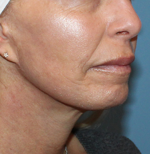 Facelift Before and After | SGK Plastic Surgery