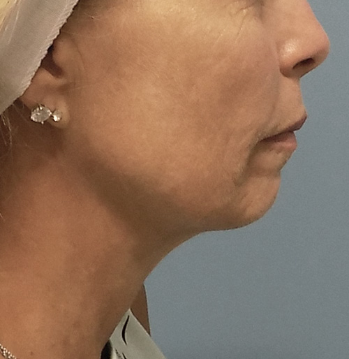 Facelift Before and After | SGK Plastic Surgery