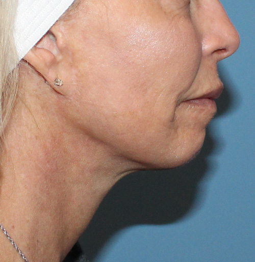 Facelift Before and After | SGK Plastic Surgery