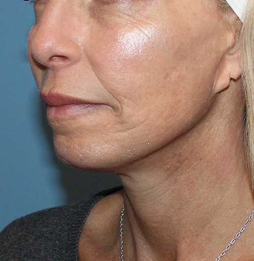 Facelift Before and After | SGK Plastic Surgery