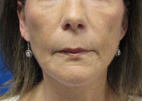 Facelift Before and After | SGK Plastic Surgery