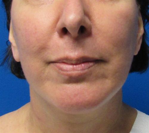 Facelift Before and After | SGK Plastic Surgery