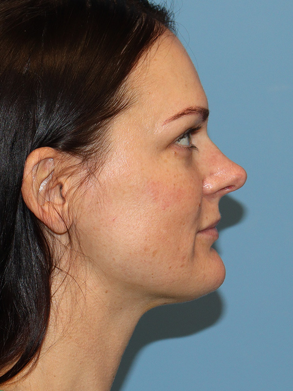 Rhinoplasty Before and After | SGK Plastic Surgery